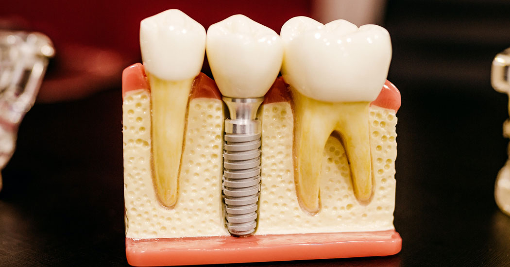 Dental Implants are done at Tamhankar Dental Navi Mumbai Raigad