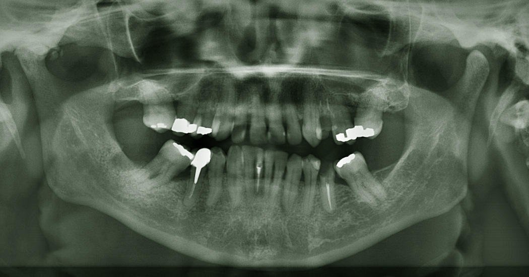 Digit | OPG| Intra Oral X-Ray