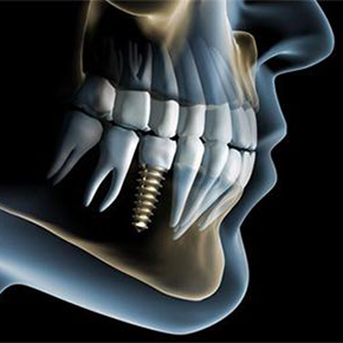 Deantal Implant at Tamhnakr Dental since 1972